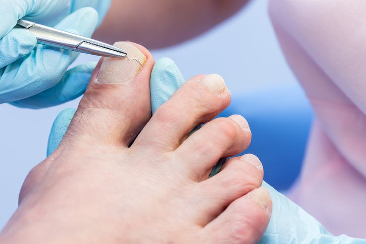 Czy wrastający paznokieć zawsze boli- Podolog Zakliczyn